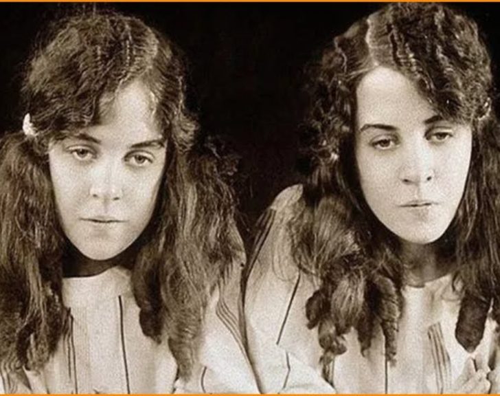 The Tragic Story of the Conjoined Hilton Twins - Trendy Matter