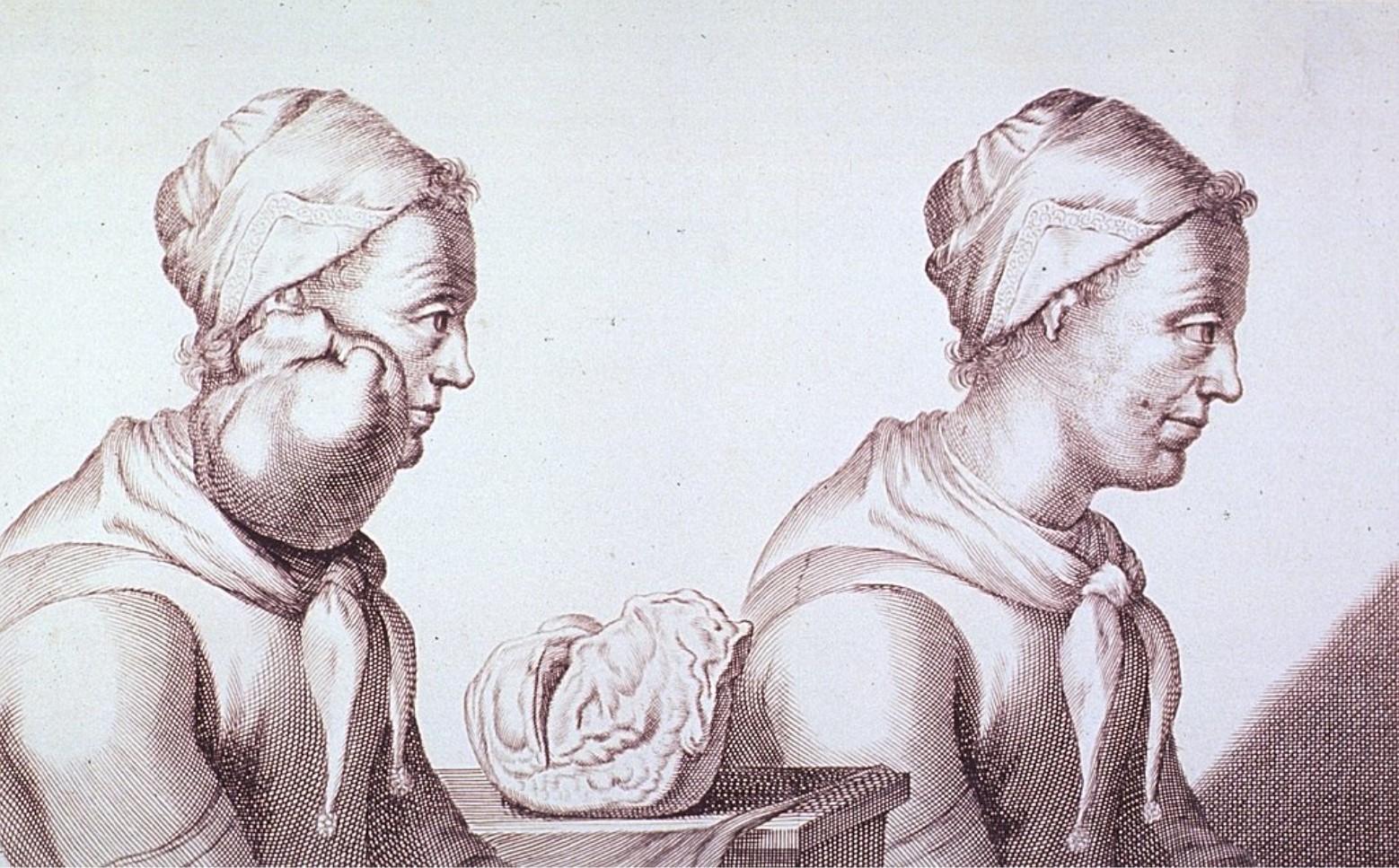 Clara Jacobi Publication, a Dutch woman who had a tumor removed from her neck in 1689 from Images from the History of Medicine