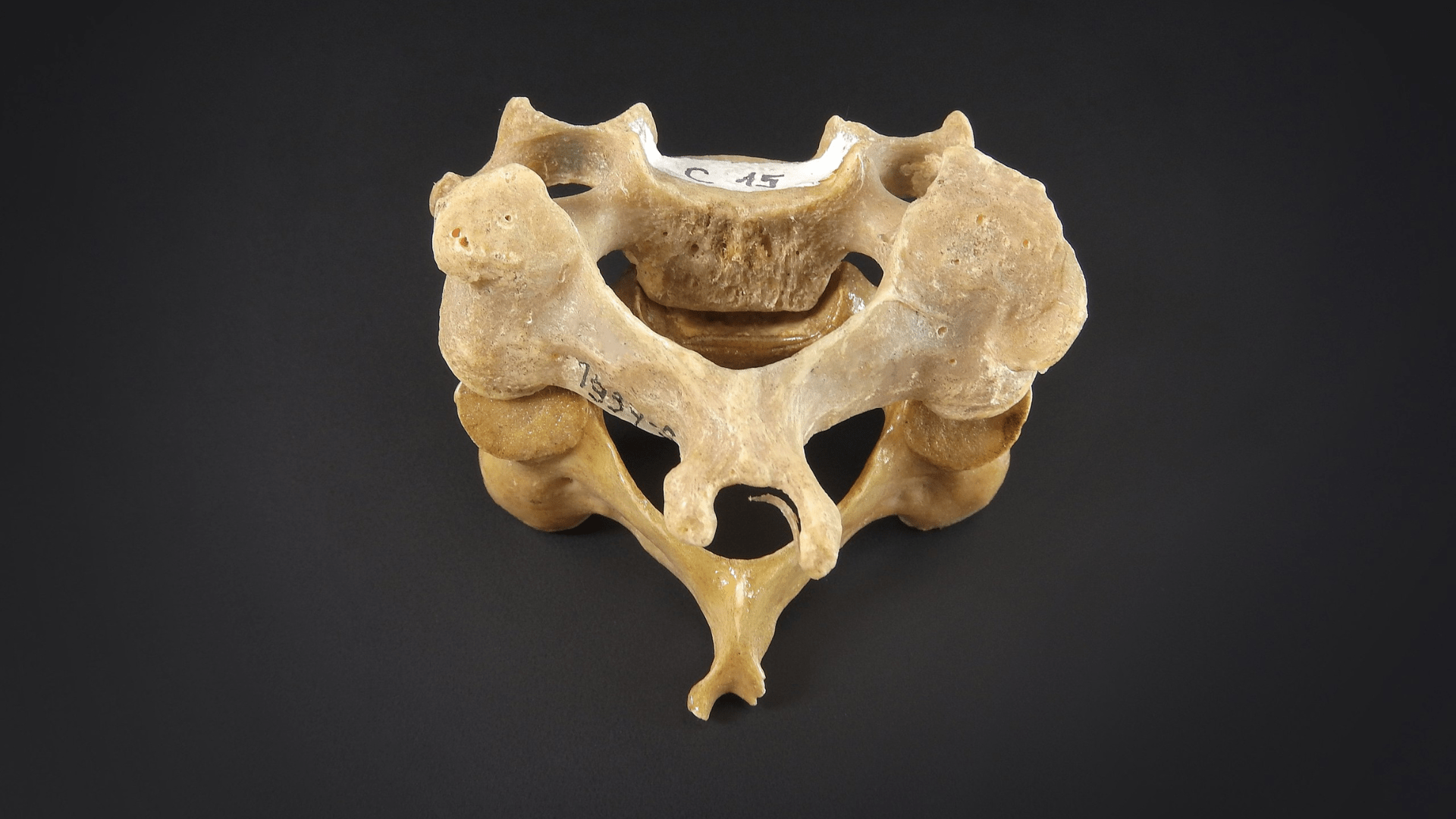 A human vertebra sitting on a gray background.
