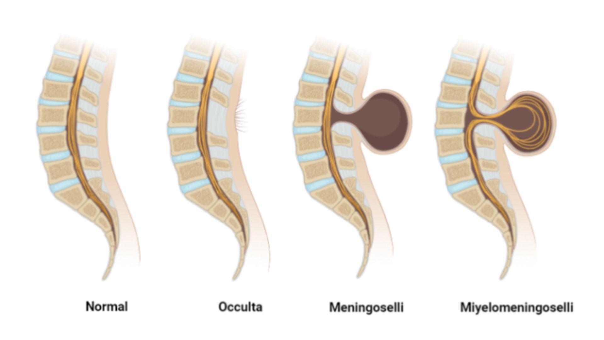 Versions of spina bifida. This includes a normal spine, occulta, meningoselli, and miyelomeningoselli.