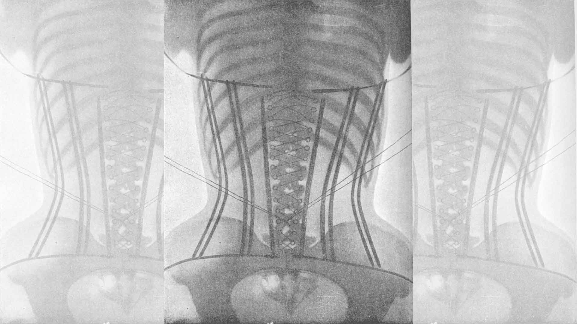X-ray of a woman in a corset